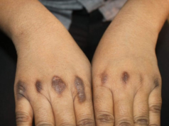How to Get Rid of Dark Knuckles With Natural Remedies