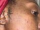 The Dilemma of Acne, Types, Causes and the Most Effective Ways to Treat It