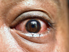 Red Eyes? 10 Common Causes and Simple Ways to Get Relief