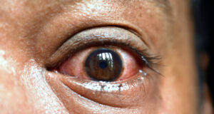 Red Eyes? 10 Common Causes and Simple Ways to Get Relief