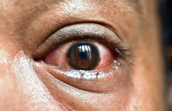 Red Eyes? 10 Common Causes and Simple Ways to Get Relief