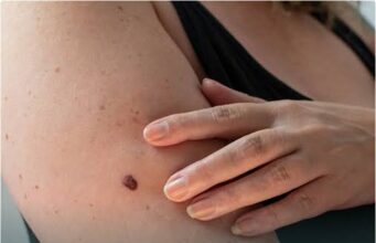 When Cancer Start Growing In Your Body You Will Notice These 10 Signs And Symptoms