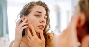 Five Widespread Misconceptions About Acne (Pimples) Everyone Should Know