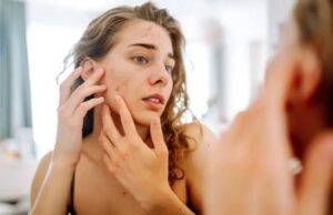 Five Widespread Misconceptions About Acne (Pimples) Everyone Should Know