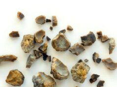7 Natural Ways to Help Prevent Kidney Stones and Protect Your Kidneys