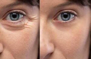 How to Reduce Wrinkles Under Your Eyes and Keep Your Skin Looking Younger