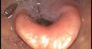 Your Saliva May Help Heal Wounds Faster, Study Reveals