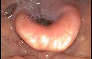 Your Saliva May Help Heal Wounds Faster, Study Reveals